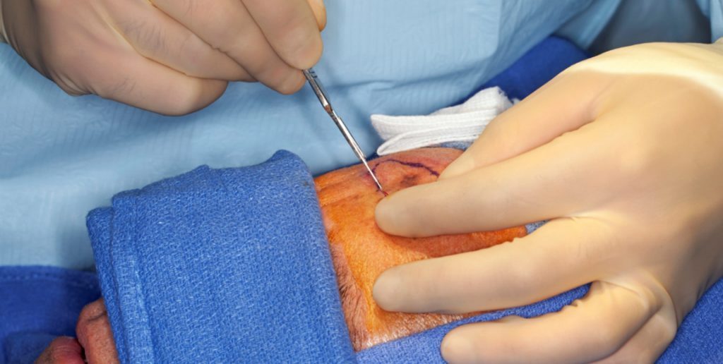 Skin Cancer Surgical Treatments